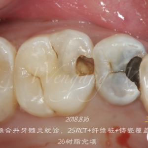 25铸瓷高嵌体7年后复查，34根管一体化修复
